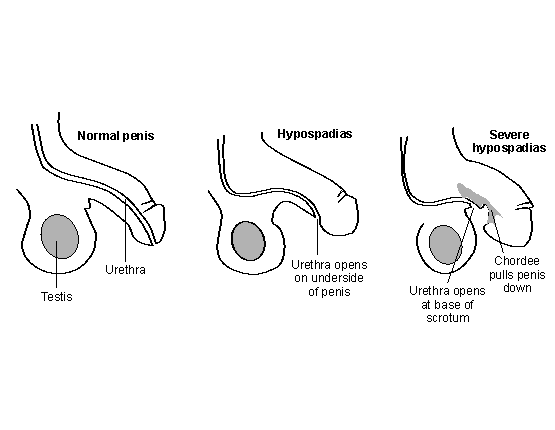 penile surgery in baby boys