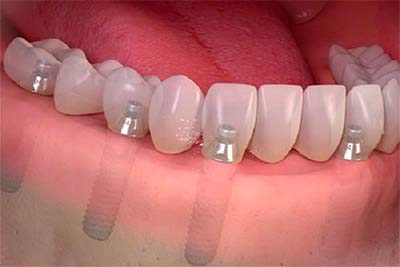 Full Mouth Dental Implants