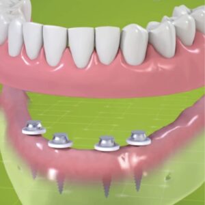 Mini Dental Implants