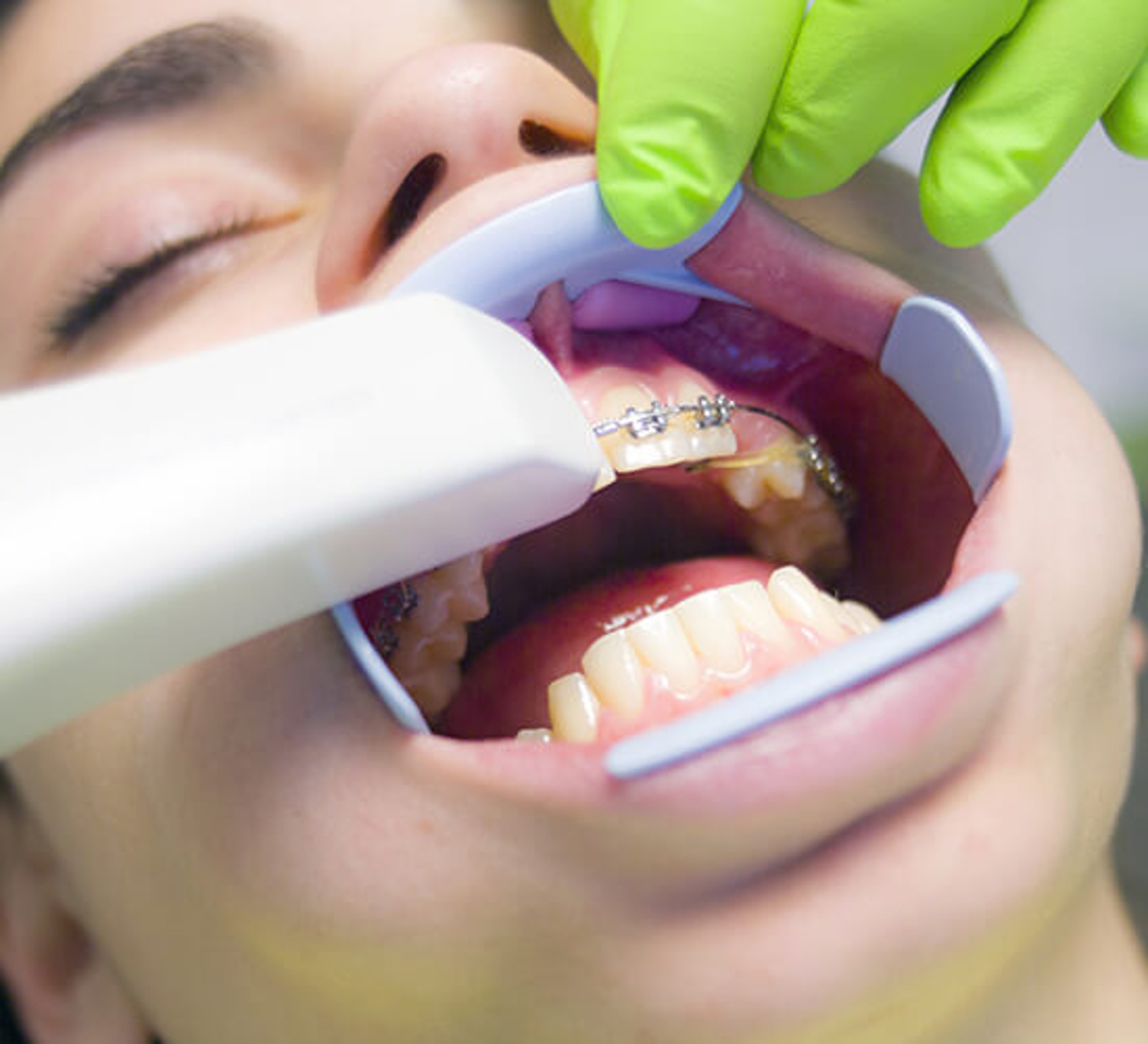 Root Canal specialist Treatment in kharadi