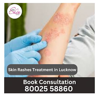 Skin Rashes Treatment in Lucknow