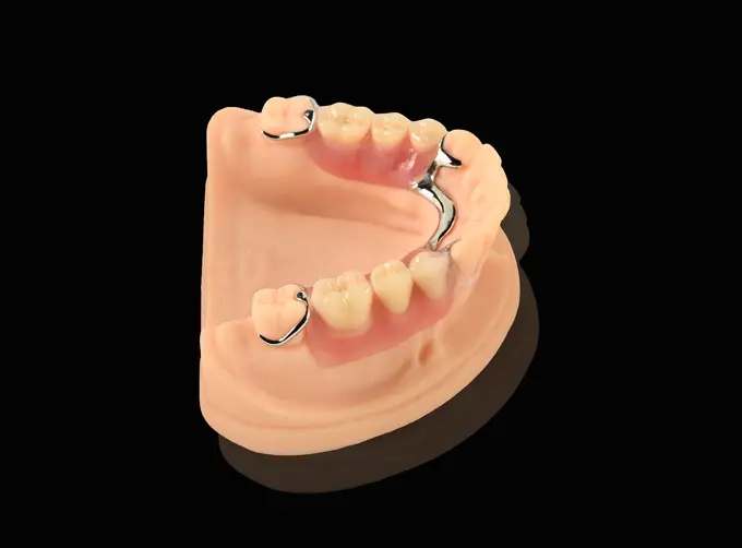 Printed Partial Framework - Co-Cr & Acrylic Partial Denture