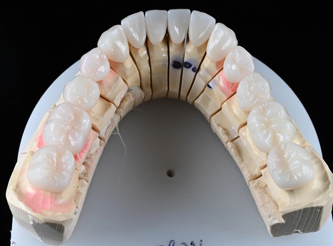 Layered Zirconia (Cut-back)