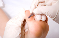 Callus, Corn and Wart treatment