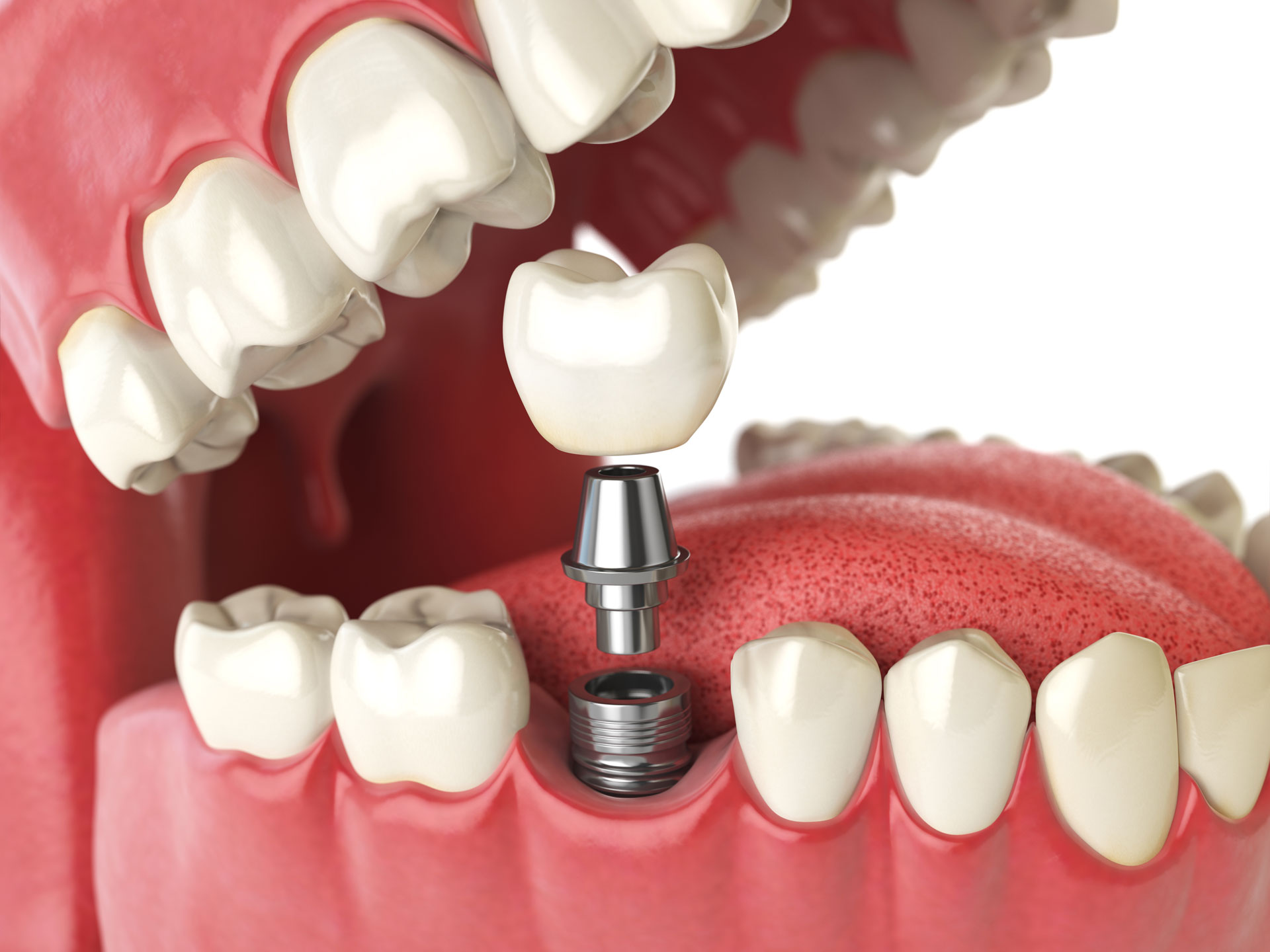 Dental implantlar