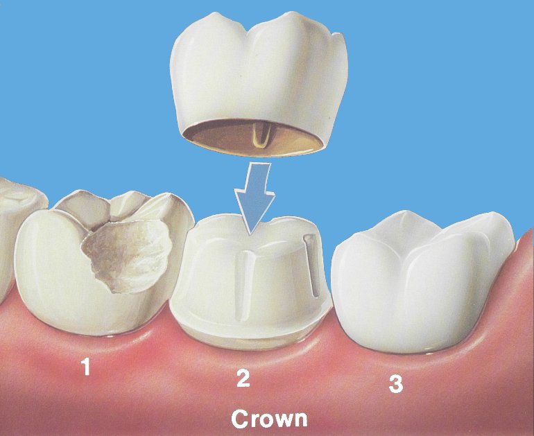 Implantat meno