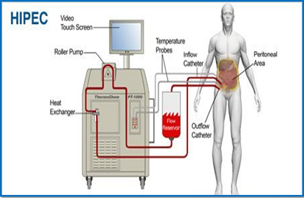 Aparatură de termoterapie pentru tratarea cancerului