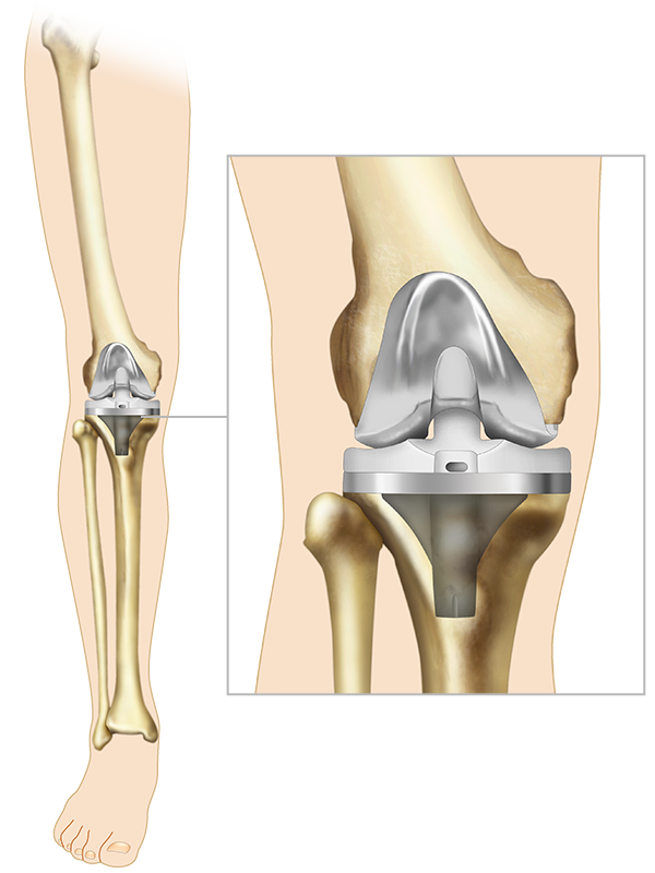 Appareils et instruments médicaux