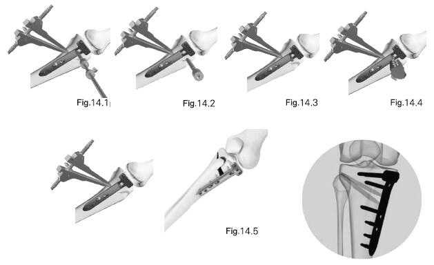 Periarticular Locking Plate